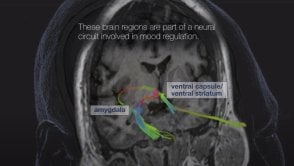 „Personalizowane” implanty mózgu szansą dla chorych na depresje